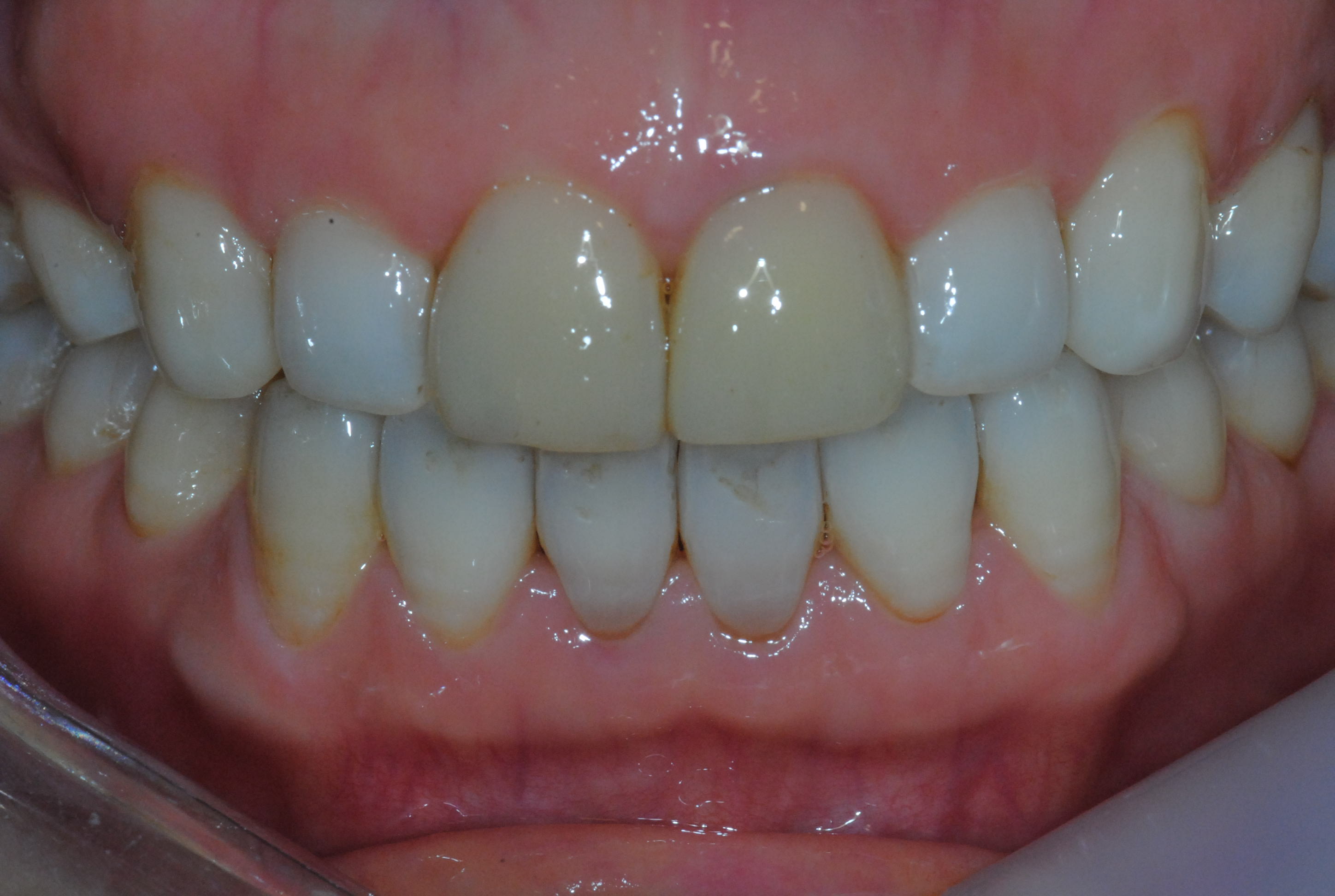 전 (Discolored teeth).JPG